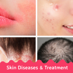 Skin disorders - Skin